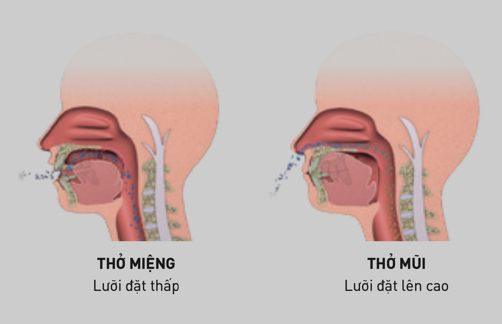 Máng chống ngáy và điều chỉnh đường thở Myosa